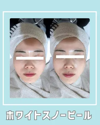 |ピーリング・毛穴| soina神楽坂のエステ・リラクイメージ