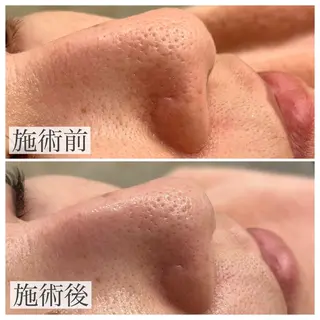 emiluca西目/ 毛穴洗浄/細胞美容のエステ・リラクイメージ