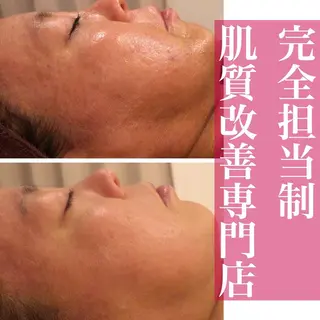 ニキビ特化型エステ 🍓最短で肌質改善のエステ・リラクイメージ