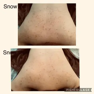 ニキビ/肌質改善専門 Snow skinのエステ・リラクイメージ