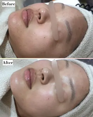 |ピーリング・毛穴| soina神楽坂のエステ・リラクイメージ