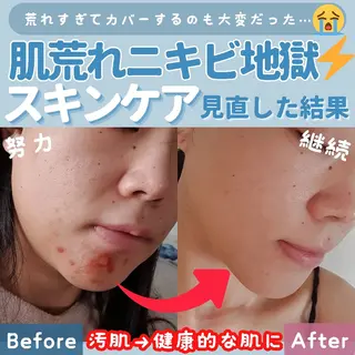 痩身ハーブピーリング 筋膜リリース☆B&Hのエステ・リラクイメージ