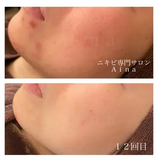 ロング カラー パーマ ヘアアレンジ メンズ キッズ ネイル マツエク・マツパ ニキビ跡専門サロン Ainaのエステ・リラクイメージ