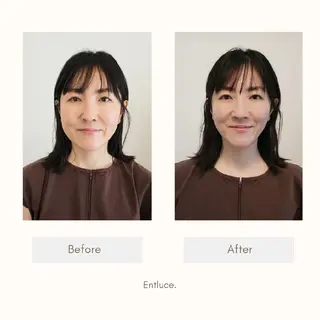 即効⚡小顔美容鍼🪡 むくみたるみ脂肪解消のエステ・リラクイメージ