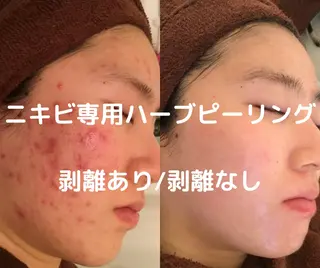 ニキビ/肌質改善専門 Snow skinのエステ・リラクイメージ