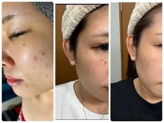 ニキビ毛穴専門店Beautysalon Luana所属・小林 まいのエステ・リラクイメージ