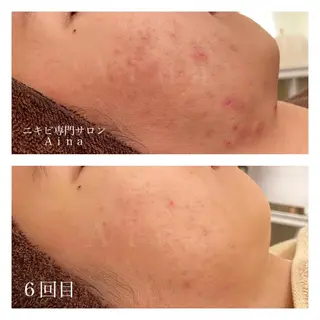 ミディアム カラー パーマ ヘアアレンジ メンズ キッズ ネイル マツエク・マツパ ニキビ跡専門サロン Ainaのエステ・リラクイメージ