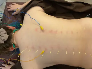 美楽鍼 びらくしんのその他イメージ