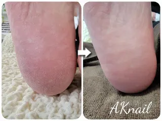 ネイル&巻き爪サロン 　AKnailのネイルデザイン