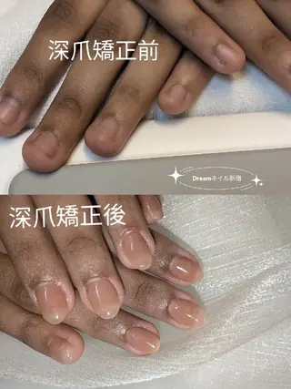 ネイル ネイリストゆか💅 長さだし、深爪矯正のネイルデザイン