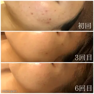 毛穴ニキビ専門 ビューティーグランツのエステ・リラクイメージ