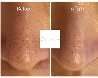 beauty & health salon Chou chou所属・ニキビ・毛穴🌿肌を 育てるララピール✨のエステ・リラクイメージ