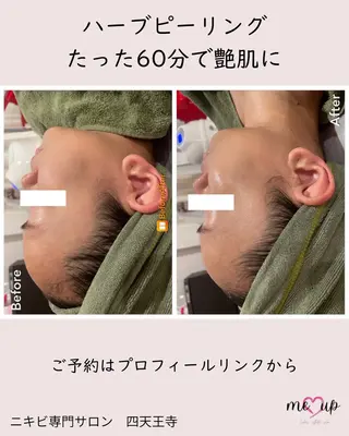 Meupニキビ専門店 背中/ハーブ/肌管理のその他イメージ