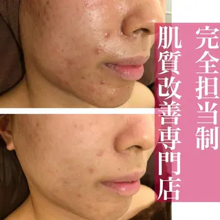 6万人の美肌実績🔥 最短ニキビ改善のエステ・リラクイメージ