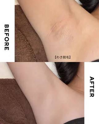 キッズ 💠mariange💠(脱毛・ハーブピーリング)所属・mariange 〜美肌・美容脱毛〜のエステ・リラクイメージ