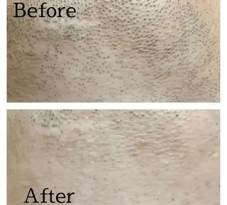 メンズ 医療提携メンズ脱毛 CDFAkasakaのエステ・リラクイメージ