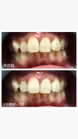 ネイル/耳つぼ /新ホワイトニングのネイルデザイン