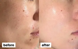 Beauty salon ~Ohana~所属・【ニキビ肌改善】 肌質改善Ohanaのエステ・リラクイメージ