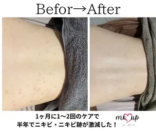 Meupニキビ専門店 背中/ハーブ/肌管理のその他イメージ