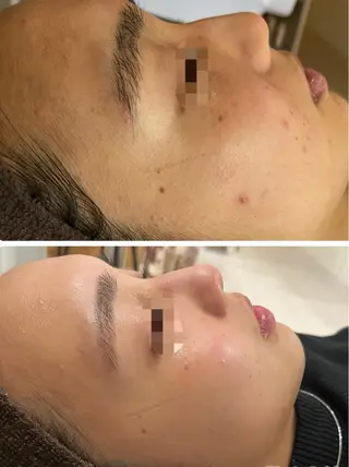 【リベルハーブピーリング認定店】敏感肌・美白脱毛専門店Dione立川店所属・Dione 立川店のエステ・リラクイメージ