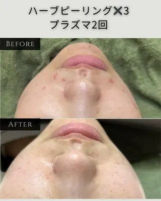 シミ毛穴|眉Wax THE  flowのエステ・リラクイメージ