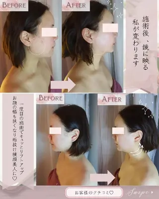 痩身ハーブピーリング 筋膜リリース☆B&Hのエステ・リラクイメージ