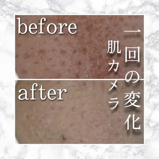 🔥3か月で肌革命 🔥ニキビ専門店のエステ・リラクイメージ