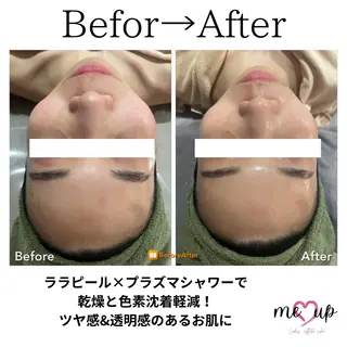 Meupニキビ専門店 背中/ハーブ/肌管理のその他イメージ