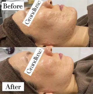 ハーブピーリング 綺肌-KIKI- 銀座店所属・🌿‬ハーブKIKI sawako🌿‬のエステ・リラクイメージ