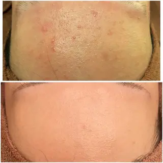 ニキビ特化型エステ 🍓最短で肌質改善のエステ・リラクイメージ