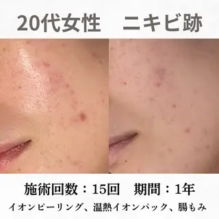 重度ニキビ専門🌷 ダウンタイムなしのエステ・リラクイメージ