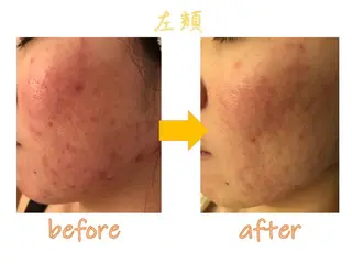 ニキビ専門サロン ド　ミモザのエステ・リラクイメージ