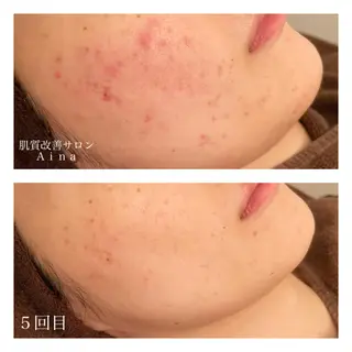 ミディアム カラー パーマ ヘアアレンジ メンズ ネイル マツエク・マツパ ニキビ跡専門サロン Ainaのエステ・リラクイメージ