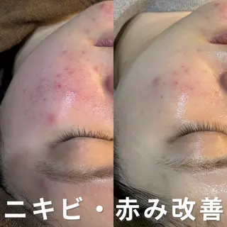 ニキビ・ニキビ跡改善 leoloのエステ・リラクイメージ