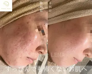 ハーブピーリング・毛穴ケア専門サロンSalon de LENA 栄店所属・ハーブピーリング専門 サロンドレナ　白藤のエステ・リラクイメージ