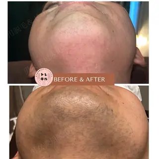 男女兼用脱毛＆ドライ ヘッドスパ トレテルのエステ・リラクイメージ