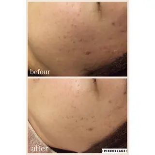 ニキビ跡専門サロン Ａｉｎａのエステ・リラクイメージ