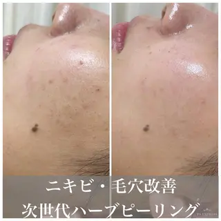 マツエク・マツパ ニキビ・毛穴改善 🌿ハーブピーリングのエステ・リラクイメージ