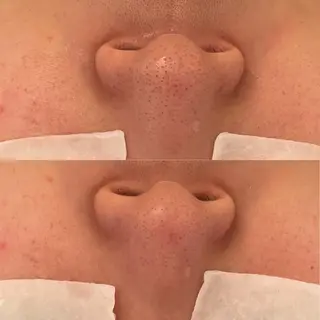 毛穴ケア/毛穴診断/ 毛穴洗浄〔心斎橋〕のエステ・リラクイメージ