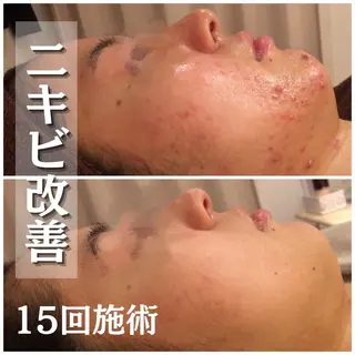 都内で出来る肌管理！ 最短ニキビ改善のエステ・リラクイメージ