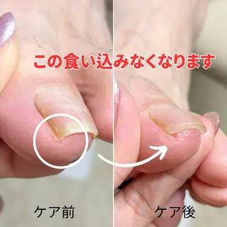 ネイル 深爪・巻き爪 専門サンセリテのネイルデザイン