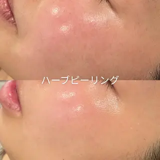 EST BEAUTY所属・顔ワックス脱毛/ ハーブピーリングのエステ・リラクイメージ