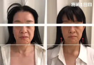 顔脱毛＆毛穴＆ニキビ 優良№1♪ヒロコ♪のエステ・リラクイメージ