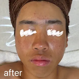 肌質改善|天王寺 For...はるかのエステ・リラクイメージ