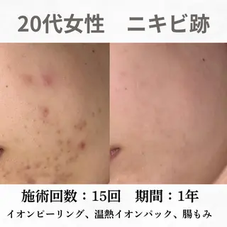 重度ニキビ専門🌷 ダウンタイムなしのエステ・リラクイメージ