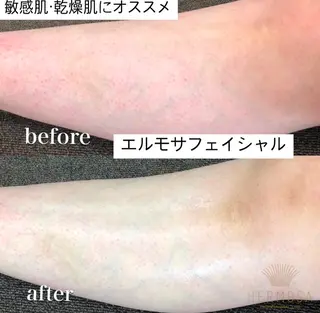 【ハーブピーリング】 Allumentのエステ・リラクイメージ