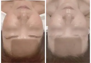 頭蓋骨小顔矯正 ハーブピーリングのエステ・リラクイメージ