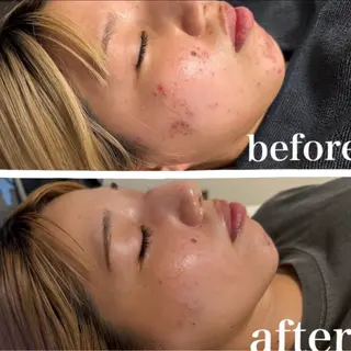 小顔・毛穴/ニキビ/ ハーブピーリング専門のエステ・リラクイメージ