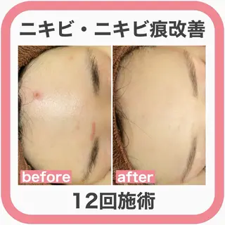 学生ニキビ改善🍀 優しい肌質改善のエステ・リラクイメージ