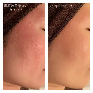 ミディアム カラー パーマ ヘアアレンジ メンズ キッズ ネイル マツエク・マツパ ニキビ跡専門サロン Ａｉｎａのエステ・リラクイメージ